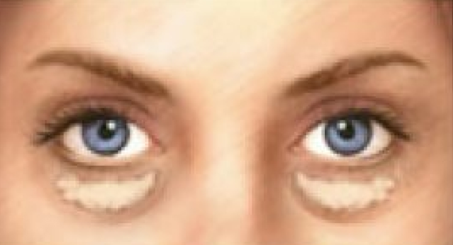 La blépharoplastie inférieure